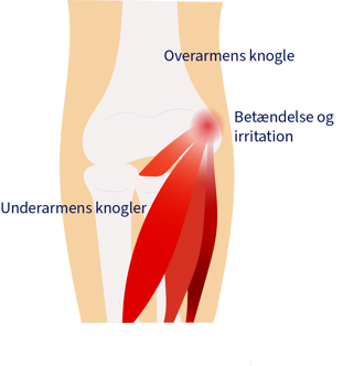 Tennis elbow