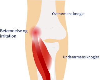 Golfers elbow